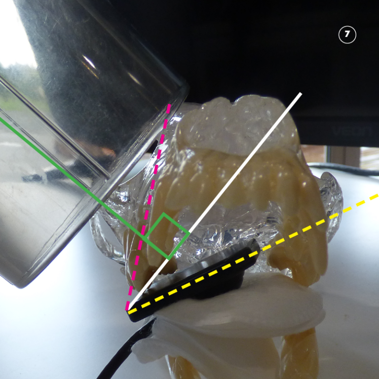 Dental Xray positioning guide Maxillary Molars 109 and 110 D.A.V.I